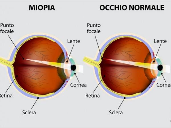 Miopia large