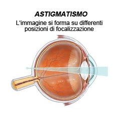 astigmatismo large