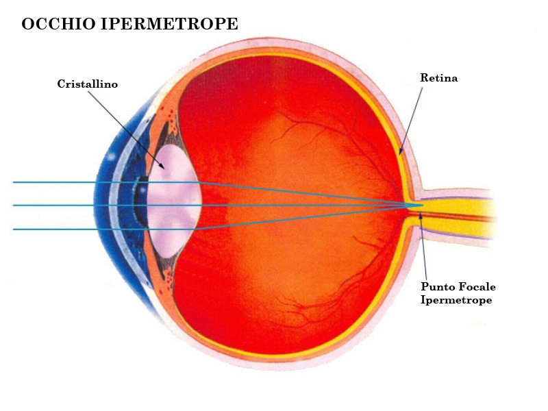 occhio ipermetrope