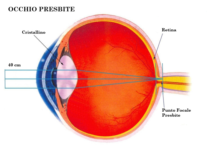 presbiopia